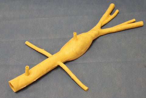 Abdominal Aortic Aneurysm (AAA) Model